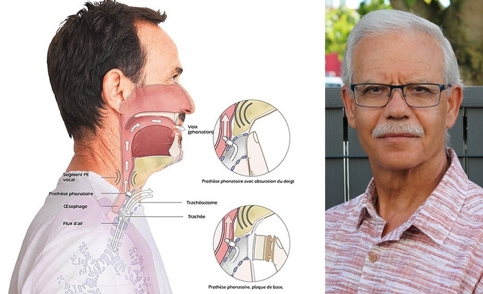 Abdellaziz Ben-Jebria: Comment peut-on retrouver la parole après un cancer du Larynx ? 